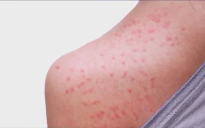 Measles Outbreak in Williamson County: Understanding Symptoms and Impact