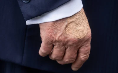 Trump’s Health Concerns: Understanding Chronic Venous Insufficiency